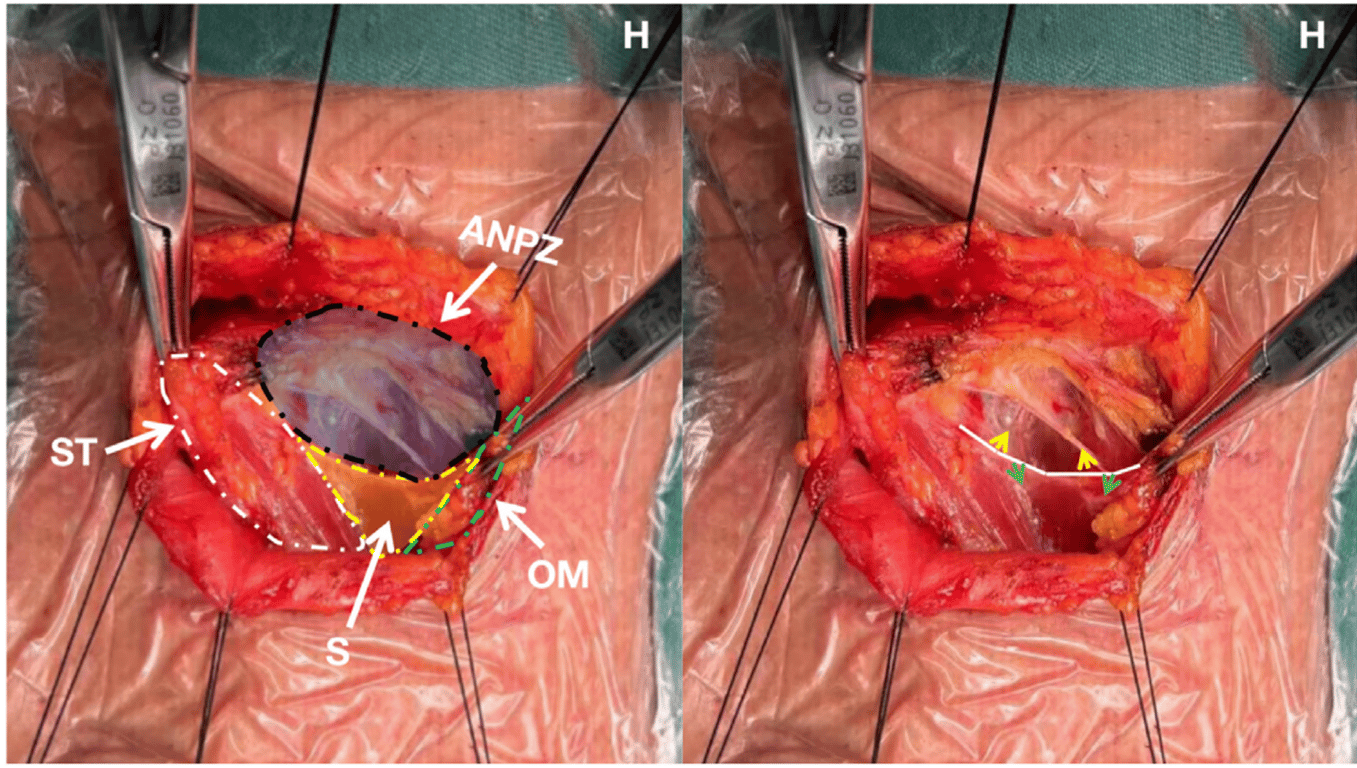The picture shows the intraoperative image of the pharyngeal plexus Autonomic Neuroprotection Zone. ANPZ, autonomic neuroprotection zone; H, head side; OM, omohyoid; S, septum; ST, sternocleidomastoid. With the septum as the boundary, the gap indicated by the green arrow is a safety gap, and the g