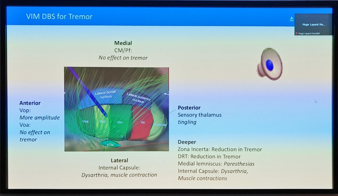 VIM DBS for Tremor Anterior Vop: More amplitude Voa: No effect on tremor Hugo Layud Hugo Horsfall Medial CM/Pf: No effect on tremor Laterai Dos V,op Vim ,zvc ulvi STN Lateral Internal Capsule: Dysarthria, muscle contraction Posterior Sensory thalamus tingling Deeper Zona Incerta: Reduction in Tremor DRT: Reduction in Tremor Medial lemniscus: Paresthesias Internal Capsule: Dysarthria, Muscle contractions 