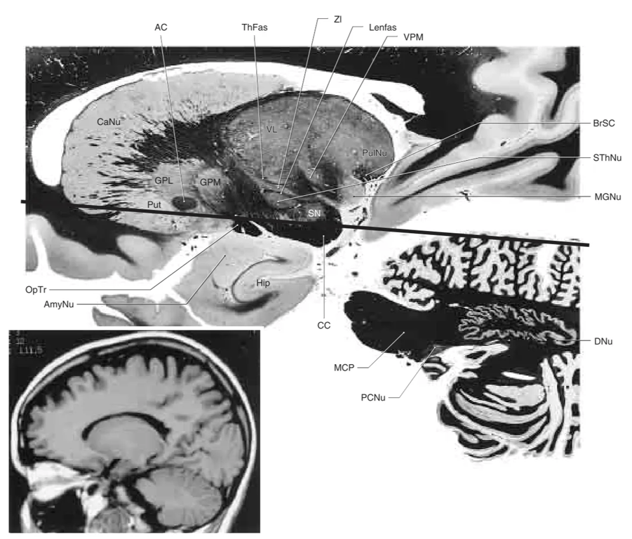 Sagittal section through the caudate nucleus, central parts of the diencephalon (ventral posteromedial nucleus), and lateral portions of the pons and cerebellum (dentate nucleus). The heavy line represents the approximate plane of the axial section. Many of the structures labeled in this photograph can be clearly identified in the adjacent T1-weighted MRI.