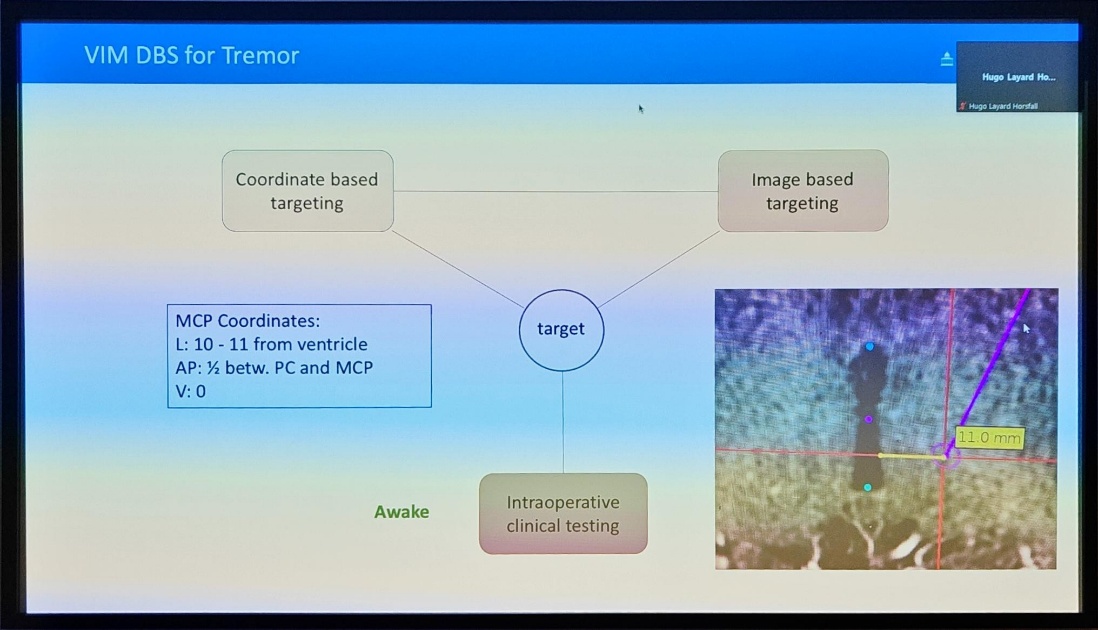 VIM DBS for Tremor Coordinate based targeting MCP Coordinates: L: 10 - 11 from ventricle AP: 1/2 betw. PC and MCP Awake Image based targeting target Intraoperative clinical testing L"Ed % *ago Layrd 11.0 mm 