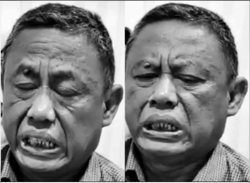 Blepharospasm and oromandibular dystonia of Meige syndrome patient