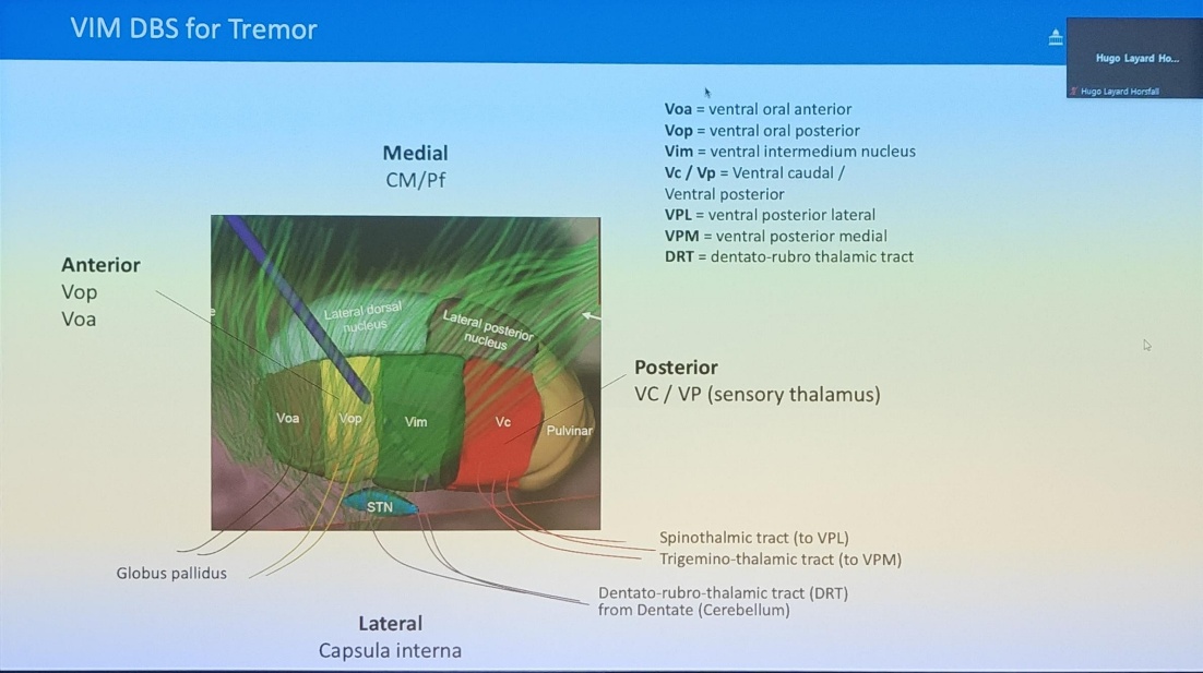 VIM DBS for Tremor Anterior Vop Voa Voa Globus pallidus Medial CM/Pf top} , STN Vim Pulvinar Hugo Layard Hugo Layard Horsfag Voa = ventral oral anterior Vop = ventral oral posterior Vim = ventral intermedium nucleus Vc/Vp = Ventral caudal / Ventral posterior VPL = ventral posterior lateral VPM = ventral posterior medial DRT = dentato-rubro thalamic tract Posterior VC / VP (sensory thalamus) Spinothalmic tract (to VPL) Trigemino-thalamic tract (to VPM) Dentato-rubro-thalamic tract (DRT) from Dentate (Cerebellum) Lateral Capsula interna 