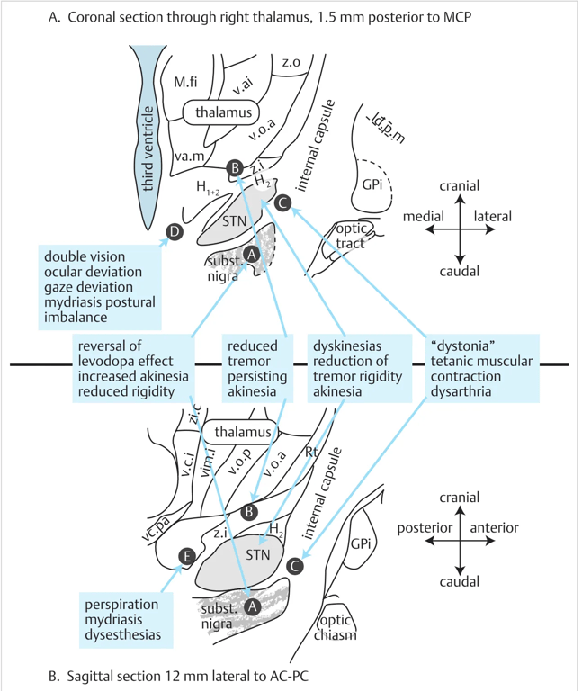 Illustration of some targets for functional brain surgery. AC: anterior commissure; GPi: globus pallidus interna; H₁: Forel’s H₁ field; MCP: midcommissural point (halfway between AC and PC); PC: posterior commissure; STN: subthalamic nucleus; Subst. nigra: substantia nigra; z.i: zona incerta.