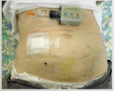 Close-up of a person's stomach with an infusion needle AI-generated content may be incorrect.