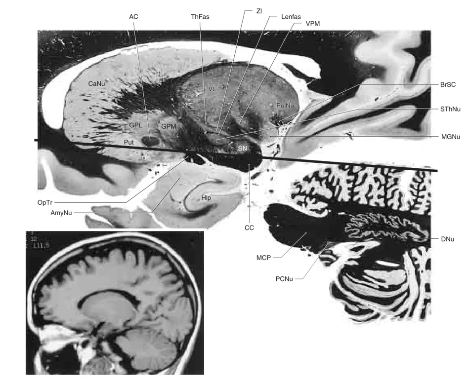 Sagittal section through the caudate nucleus, central parts of the diencephalon (ventral posteromedial nucleus), and lateral portions of the pons and cerebellum (dentate nucleus). The heavy line represents the approximate plane of the axial section. Many of the structures labeled in this photograph can be clearly identified in the adjacent T1-weighted MRI.