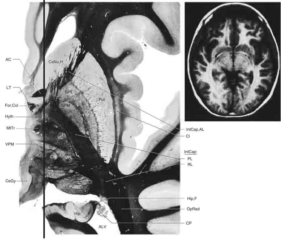 Axial section through the head of the caudate nucleus, ventral posteromedial nucleus, medial geniculate body, and ventral parts of the pulvinar. The heavy line represents the approximate plane of the sagittal section. Many of the structures labeled in this photograph can be clearly identified in the adjacent T1-weighted MRI.