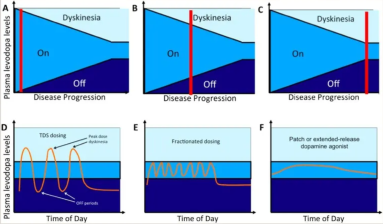 Simplified and schematic representation of motor complications in Parkinson’s disease in relation to disease progression
