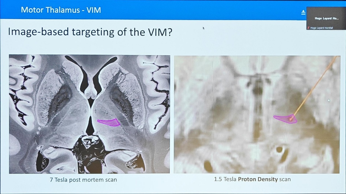 Motor Thalamus - VIM Image-based targeting of the VIM? 7 Tesla post mortem scan L."ard Hgo Lay*d Hor" 1.5 Tesla Proton Density scan 