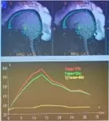 Lesion - HiFUS MR-Guided Focused Ultrasound Real-time temperature change monitoring with • sonication • correction if necessary neuro ogy check 50 45 35 MRI 10 L."Üd % Hugo 15 20 25 30 35 