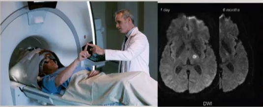 Deep Brain Stimulation (DBS) WHAT IS MRGFUS? • Under MR guidance, > 1000 ultrasound beams are directed towards theVlM thalamus • Initial low power sonifications (at 40-45c) produce transient test lesions to assess efficacy/ side effects • Followed by lesion creation (at 60c) to produce clinical effect • • HOW DOES IT COMPARE TO DBS? MRgFUS is less invasive (less infections/ battery replacements etc) Less hospital visits Similar efficacy, although long term data less certain in MRgFUS MRgFlJS can only be unilateral (DBS can be bilateral) Risks of permanent side effects paraesthesia (14%) and balance issues (9%) at I year in MRgFUS (higher than DBS) MRgFUS is not modifiable (vs DBS) 