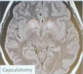 Lesions - RF Indications Movement disorders: Thalamotomy (VIM, VOP, VOA) Pallidotomy Pallido-tractotomy Pallidotomy Psychiatric: Capsulotomy Cingulotomy Pain: Thalamotomy (CM / CL) Cingulotomy Capsulotomy Layrd CM / CL-Thalamotomy 