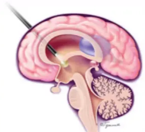 Treatment choice guided by classification • Physiological classification most important — Communicating vs obstructive — Aetiology 