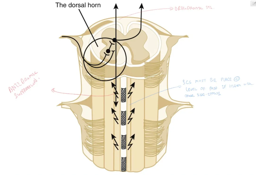 The dorsal horn Figure 128-1 The extradurally placed multipolar lead excites fibers in the dorsal columns, resulting in orthodromic activity, giving rise to the paresthesia experienced by the patient, and in antidromic activation channeled into the underlying dorsal horns via large-diameter collaterals. In the dorsal horns, this evokes neurotransmitter changes that result in an increase of inhibitory activity and a decrease of pathologic hyperexcitability. 