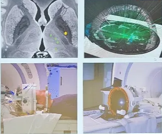 Lesion - HiFUS 1028 tiny Ultrasonic emitters in half sphere MRI guided, NOT non-invasive, incisionless, outpatient Awake patient, head shave, stx frame, Can only target deep areas, close to midline Insightec Inc, FDA approved 2017 Approved indications: Essential Tremor, PD tremor/dyskinesias, (pain) New indications: subthalamotomies for PD patients 