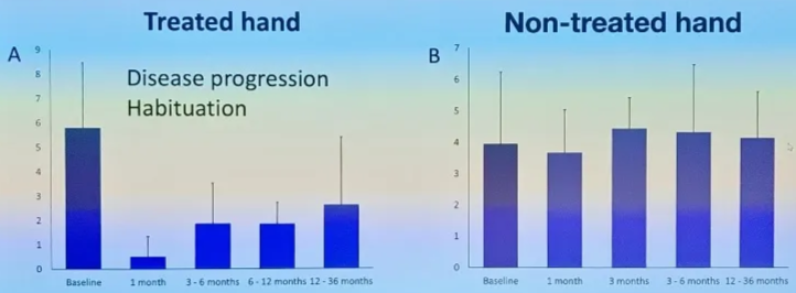 Lesion outcome Results for tremor? Hugo Layard t' Hugo Layard Horsfall Treated hand 9 Disease progression 8 7 Habituation 6 5 4 3 2 1 3-6 months 6-12 months 12-36 months Baseline 1 month Audit of RF for tremor at NHNN Evolution of Hand Tremor Score Non-treated hand 7 6 5 4 3 2 1 Baseline 1 month 3 months 3 - 6 months 12-36 months NHS 