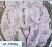 Lesions - RF Indications Movement disorders: Thalamotomy (VIM, VOP, VOA) Pallidotomy Pallido-tractotomy Pallidotomy Psychiatric: Capsulotomy Cingulotomy Pain: Thalamotomy (CM / CL) Cingulotomy Capsulotomy Layrd CM / CL-Thalamotomy 