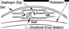 ANTISIPHON DEVICES • • Integra antisiphon device Flow restricted when pressure within device becomes negative May be affected by scarring Diaphragm (lop) Skin Periosteum - ———_———_()irectional Arrow (Bottom 