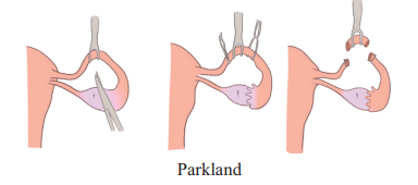 Segment excised between two ligatures