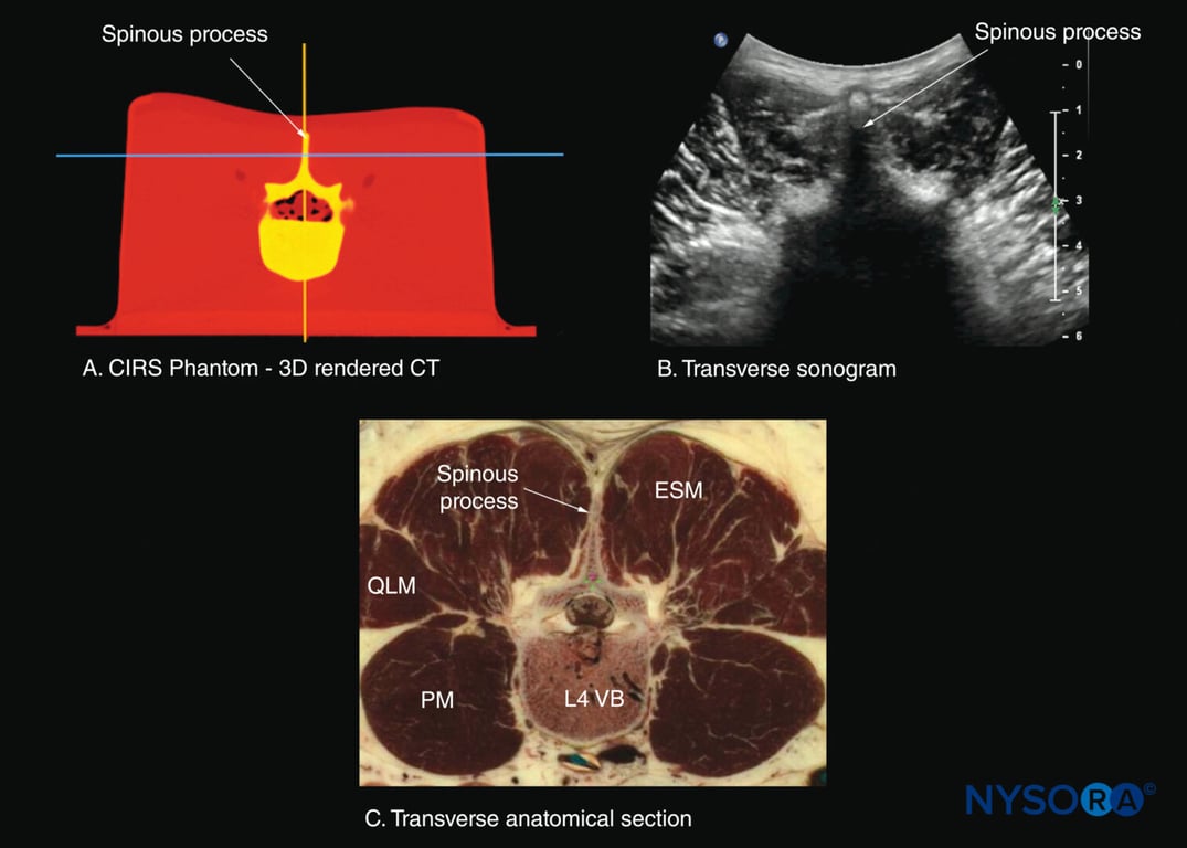 Transverse sections of the lumbar spine at the level of the L4 spinous process (SP). (A) Transverse slice rendered from a high-resolution computed tomography (CT) scan dataset from the CIRS phantom. (B) Sonogram: transverse spinous process view. (B) Transverse cadaver anatomical section. ESM, erector spinae muscle; PM, psoas major muscle; QLM, quadratus lumborum muscle; VB, vertebral body.