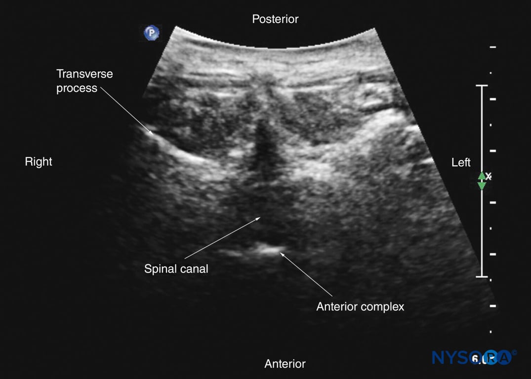 Transverse interspinous sonogram of the midthoracic region. Visualization of the posterior dura and anterior complex can be very challenging in the midthoracic region due to the acute angulation of the spinous processes and requires cranial angulation of the US transducer.