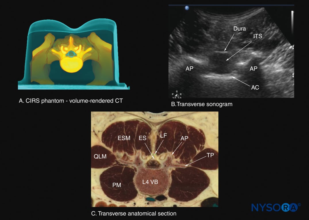Transverse sections of the lumbar spine at the level of the L3–4 interspinous space. (A) Transverse slice rendered from a high-resolution computed tomography (CT) scan dataset from the CIRS phantom. (B) Sonogram: transverse interspinous view. (C) Transverse cadaver anatomical section. AC, anterior complex; AP, articular process; ES, epidural space; ESM, erector spinae muscle; ITS, intrathecal sac; LF, ligamentum flavum; PM, psoas major muscle; QLM, quadratus lumborum muscle; TP, transverse process; VB, vertebral body.