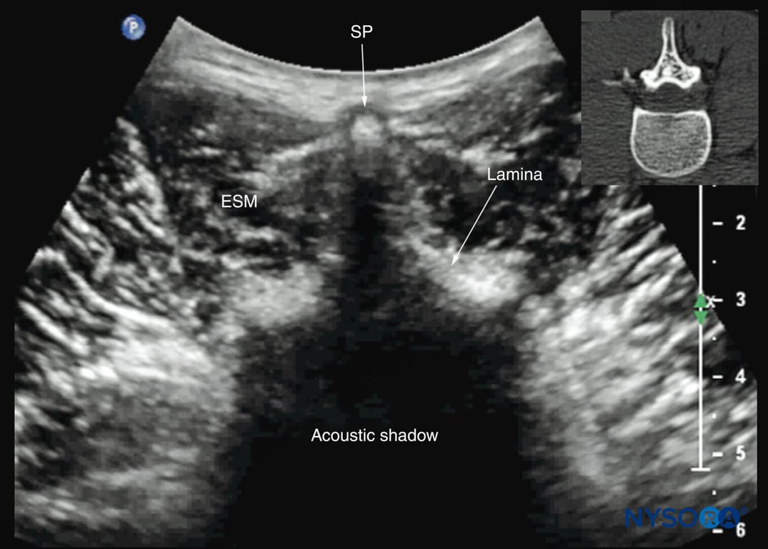 Transverse sonogram of the lumbar spine with the transducer positioned directly over the L4 spinous process (transverse spinous process view). Note the acoustic shadow of the spinous process and lamina, which completely obscures the spinal canal and the neuraxial structures. The inset image shows a corresponding computed tomography (CT) scan of the lumbar vertebra. The CT slice was reconstructed from a three-dimensional CT dataset from the author’s archive. ESM, erector spinae muscle; SP, spinous process.