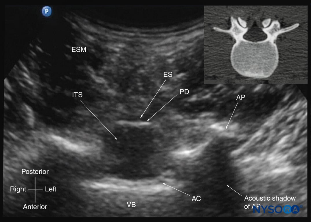 Transverse sonogram of the lumbar spine with the transducer positioned such that the US beam is insonated through the interspinous space (transverse interspinous view). The epidural space, posterior dura, intrathecal space, and anterior complex are visible in the midline, and the articular process (AP) is visible laterally on either side of the midline. Note how the articular processes on either side are symmetrically located. The inset image shows a corresponding computed tomography (CT) scan of the lumbar vertebra. The CT slice was reconstructed from a three-dimensional CT dataset from the author’s archive. AC, anterior complex; ES, epidural space; ESM, erector spinae muscle; ITS, intrathecal space; PD, posterior dura; VB, vertebral body
