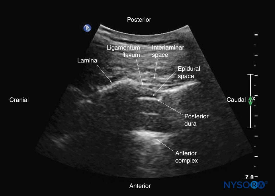 Paramedian sagittal oblique sonogram of the lower thoracic spine. The acoustic window is relatively large; through it, the ligamentum flavum, posterior dura, epidural space, and anterior complex are clearly visible.