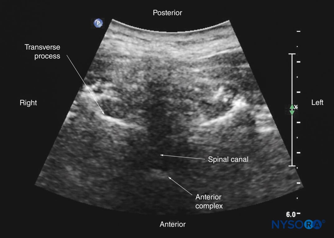 Transverse interspinous sonogram of the upper thoracic spine.