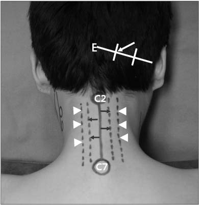 Figure 1. Surface anatomy of the posterior neck region. After dividing the line from external occipital protuberance to mastoid process into 3 sections, greater occipital nerve usually runs the point at the junction of its middle and medial thirds (white arrow). Drawing the line one finger breadth laterally from midline, there are laminae on this line (black arrows). Two finger breadths laterally, facet joints are on this line (arrowheads). E, external occipital protuberance; C2, spinous process of the 2nd cervical vertebra; C7, spinous process of the 7th cervical vertebra.