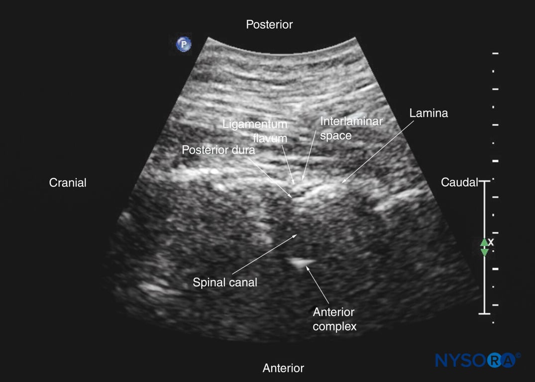 Paramedian sagittal oblique sonogram of the upper thoracic spine. The posterior dura and the anterior complex are visible through the narrow acoustic window.