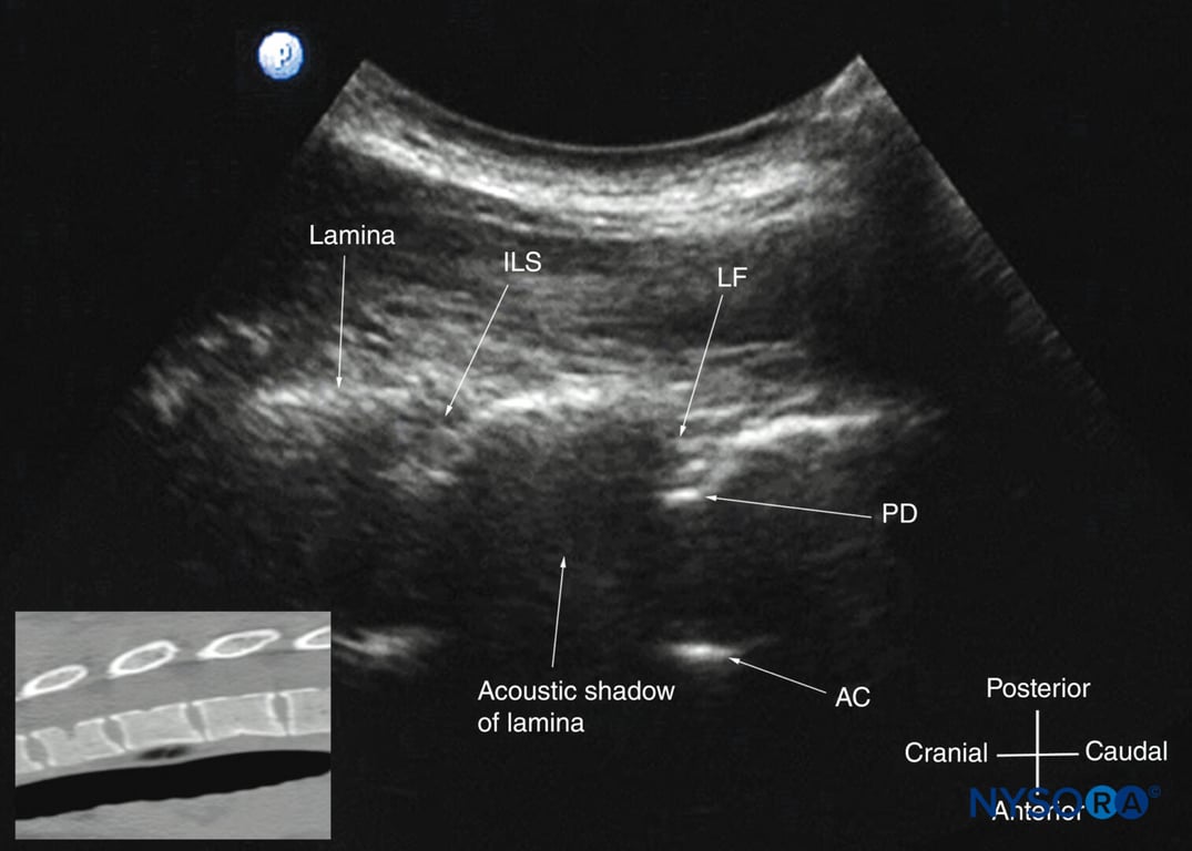 Paramedian sagittal oblique sonogram of the midthoracic spine. The posterior dura (PD) and the anterior complex (AC) are visible through the narrow acoustic window. The inset image shows a corresponding computed tomography (CT) scan of the midthoracic spine. The CT slice was reconstructed from a three-dimensional CT dataset from the author’s archive. ILS, interlaminar space; LF, ligamentum flavum.