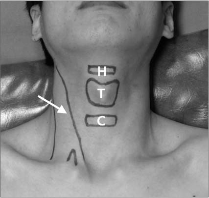 Surface anatomy of the anterior neck region. Below the chin, hyoid bone (H) situated opposite the 3rd cervical vertebra can be easily palpated at midline. A finger's breadth below, there is the laryngeal prominence of the thyroid cartilage (T). The outlines of the thyroid cartilage are readily palpated. Below its lower, anterior part of the cricoid cartilage (C) forms an important landmark on the front of the neck because it lies opposite the 6th cervical vertebra. Arrow indicates sternocleidomastoid muscle.