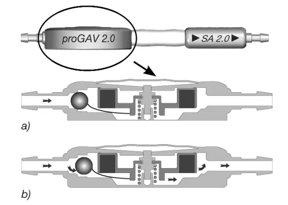 Horizontal position In the horizontal position, the gravitational unit is always open and does not present any resis- tance. proGAV 2.0 Fig. 2: Gravitational unit in horizontal body position Consequently, the opening pressure of the pro- GAV 2.0 in the horizontal body position is char- acterised by the adjustable differential pressure unit. The principal working method used by the adjustable differential pressure unit is shown in fig. 3a and b. In fig. 3a it is closed so that no drainage is pos- sible. In fig. 3b, the adjustable differential pres- sure unit is shown in the open state. proGAV2.O a) b) Fig. 3: Adjustable differential pressure unit in horizontal body position a) closed b) open 