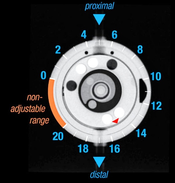 non- adjustable range 20 proximal 10 14 18 • • 16 distal 