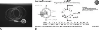 A, Complete Aesculap Miethke proGAV assembly. B, Setting code for... | Download Scientific Diagram