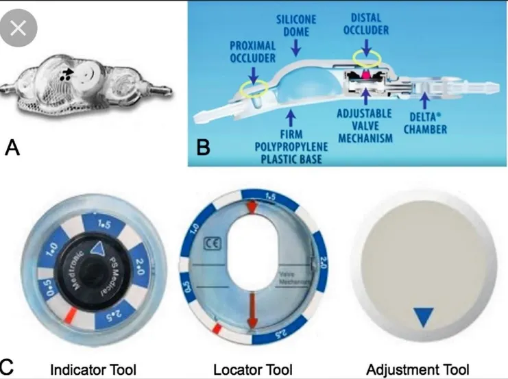 SILICONE DOME PROXIMAL OCCLUDER DISTAL OCCLUDER DELTA• CHAMBER Valve Performance Level 0.5 2.0 2.5 Opening penjng Pressure (cm Pressure (cm ADJUSTABLE VALVE FIRM MECHANISM POLYPROPYLENE Locator Tool H20) Lying 3.5 7.0 10.5 13.5 H20) Standin 3.0 5.0 12.0 14.7 Indicator Tool Adjustment Tool 