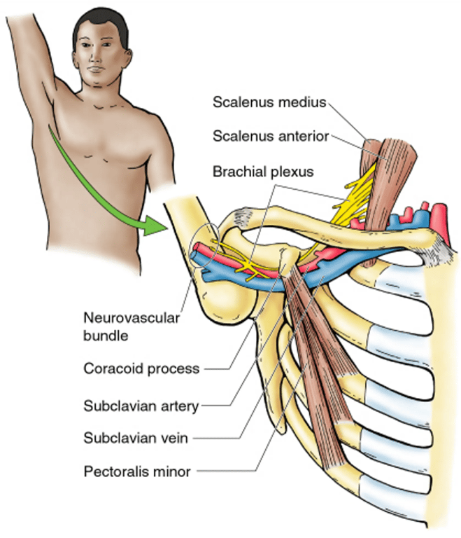 Compression of the neurovascular bundle in the axilla 