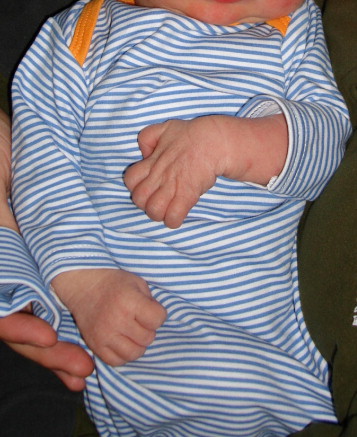 Isolated Lower Brachial Plexus (Klumpke) Palsy With Compound Arm Presentation: Case Report - ScienceDirect