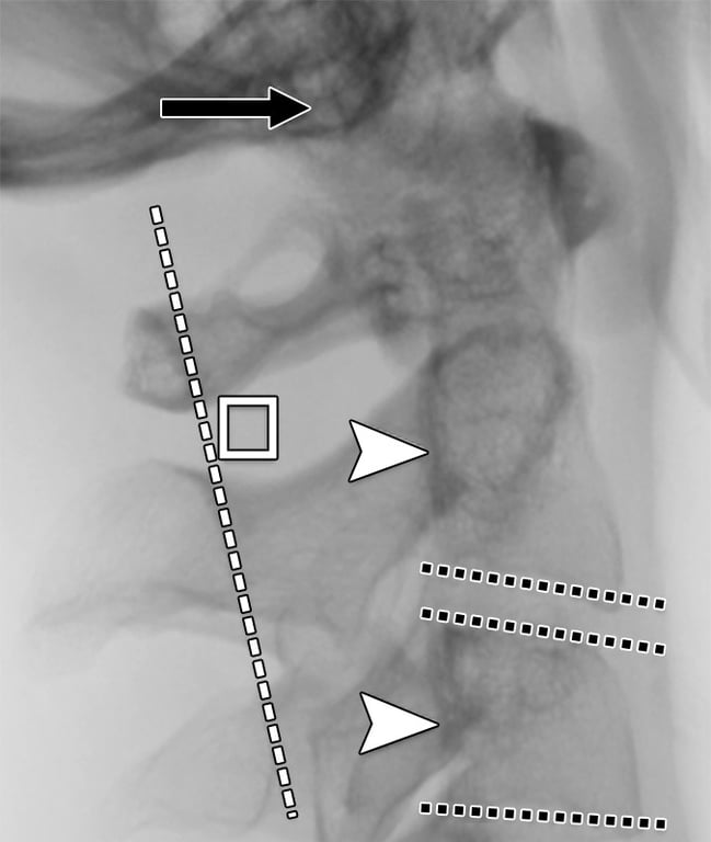 X-ray of a spine with arrows pointing to the side AI-generated content may be incorrect.