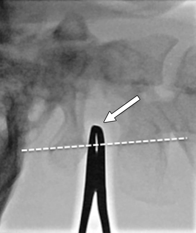 An x-ray of a person's neck AI-generated content may be incorrect.