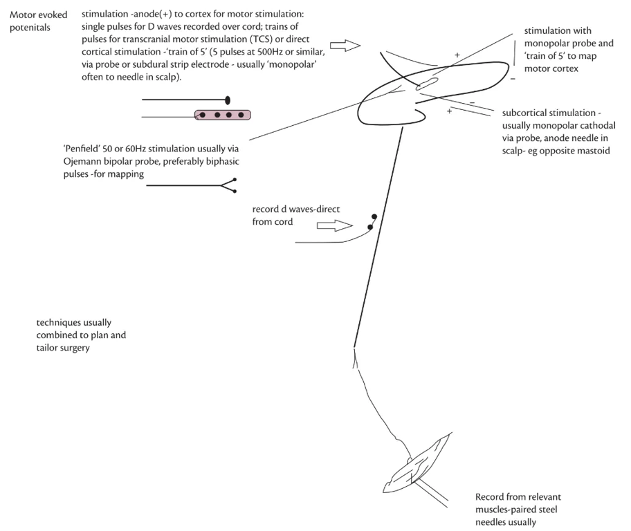 Motor evoked potenitals stimulation -anode(+) to cortex for motor stimulation: single pulses for D waves recorded over cord; trains Of pulses for transcranial motor stimulation (TCS) or direct cortical stimulation -'train Of 5' (5 pulses at 500Hz or similar, via probe or subdural strip electrode - usually 'monopolar' Often to needle in scalp). 'Penfield' 50 Or 60Hz stimulation usually via Ojemann bipolar probe, preferably biphasic pulses -for mapping record d waves-direct from cord techniques usually combined to plan and tailor surgery stimulation with monopolar probe and 'train Of 5' to map motor cortex subcortical stimulation - usually monopolar cathodal via probe, anode needle in scalp- eg opposite mastoid Record from relevant muscles-paired steel needles usually Fig. 71.3 Motor evoked potentials—stimulus can be transcranial: usually magnetic for preoperative mapping, electrical transcranial 'train of 5' in theatre for monitoring entire pathway. Applied via a subdural strip or probe direct to cortex when accessible: localization of motor areas at cortical and subcortical levels via probe stimulation. Recording distally can be over cord (D waves) or more usually muscle (M EPs): for spinal work recording from a muscle above the surgery acts as a control. 