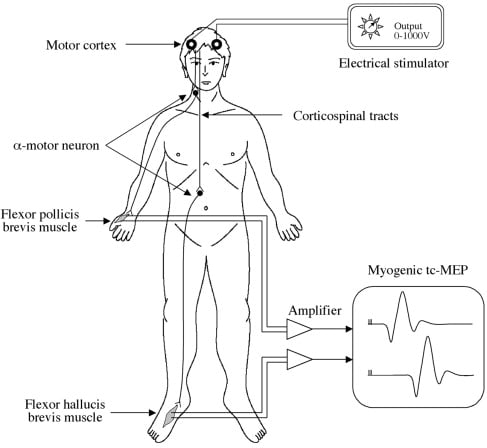 Usefulness of Transcranial Motor Evoked Potentials During ...