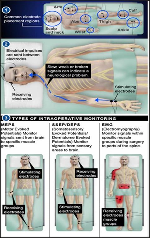 Thigh v.•rist and neck are sent weak can a neu roto•gical _ Stimulating 3 TYPES OF MONITORING MEP S Potentials) sent frorn brain e 1 •Y2troCes SS EP'OEPS Oerrnatorne sensory areas to brain _ EMG Monitor signals wRhin Surgery to parts Of the spine _ Rece n g groups 