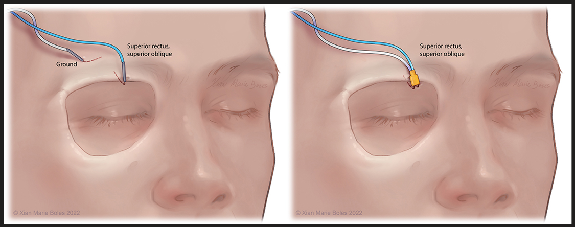 rectu s. Super i cy s u perior oblique Xian Marie 2022 Xian Marie gees 2022 