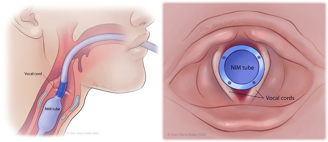 NIM tube Vocal cord Vocal cords NIM tube O Xian Marie Boles 2022 