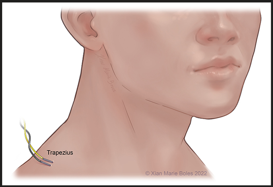 Trapezius 