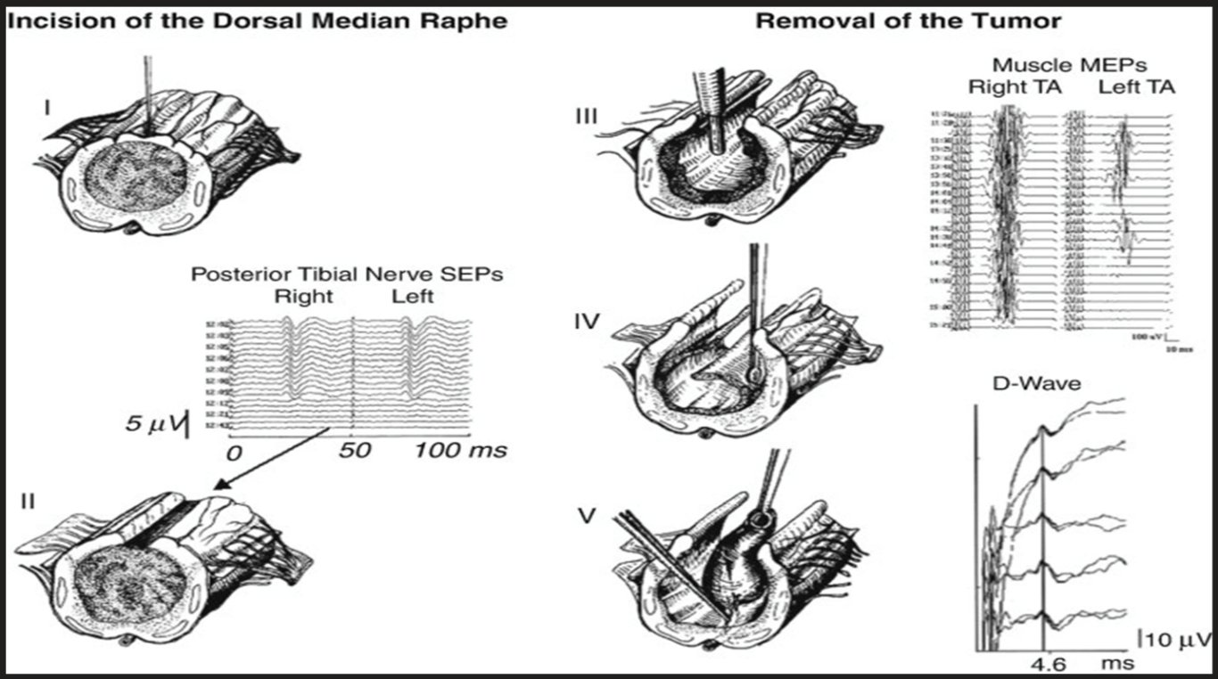 Incision Of the Dorsal Median Raphe Posterior Tibial Nerve SEPs Right Left Ill IV 100 ms Removal Of the Tumor Muscle MEPs Right TA Left TA D -VVave 50 11 0. 4.6 110 uv ms 