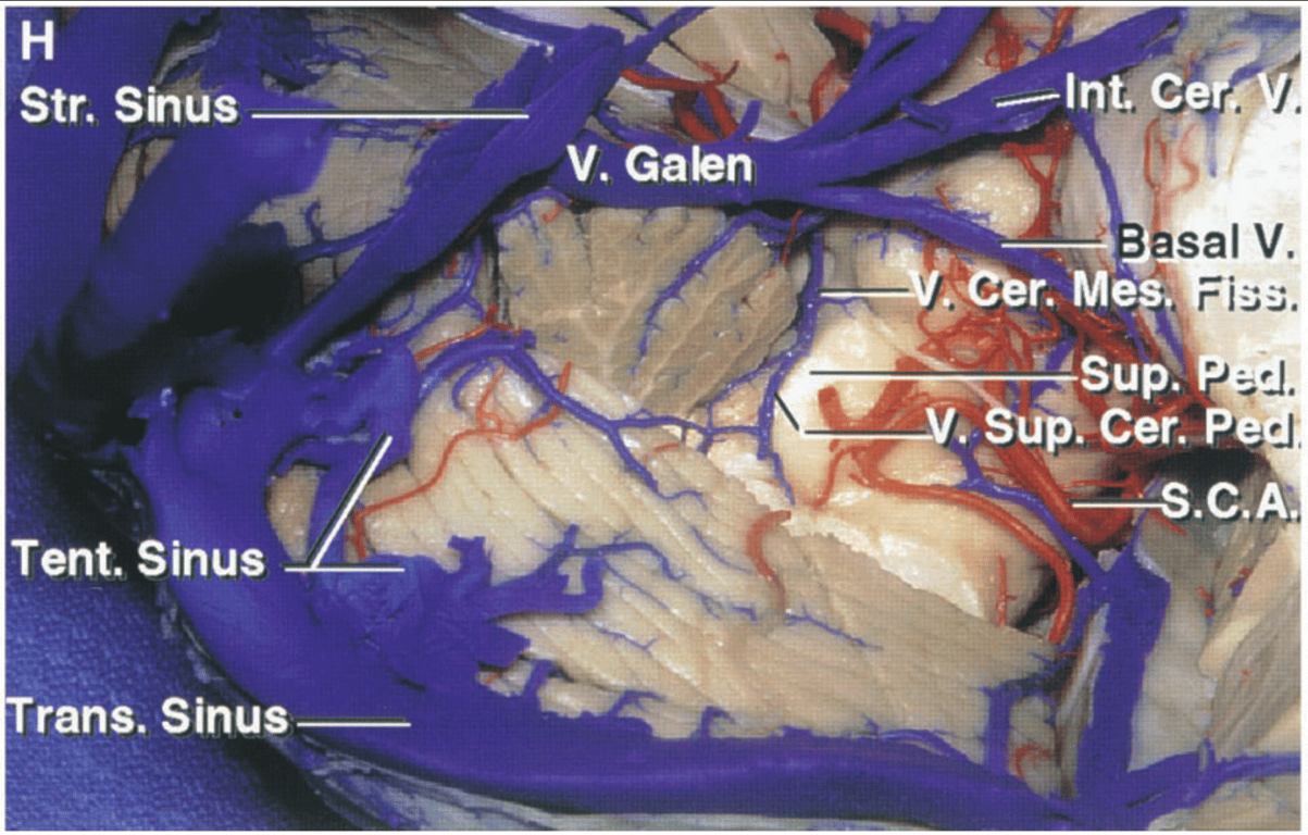 The posterior lip of the cerebellomesencephalic fissure has been removed. 