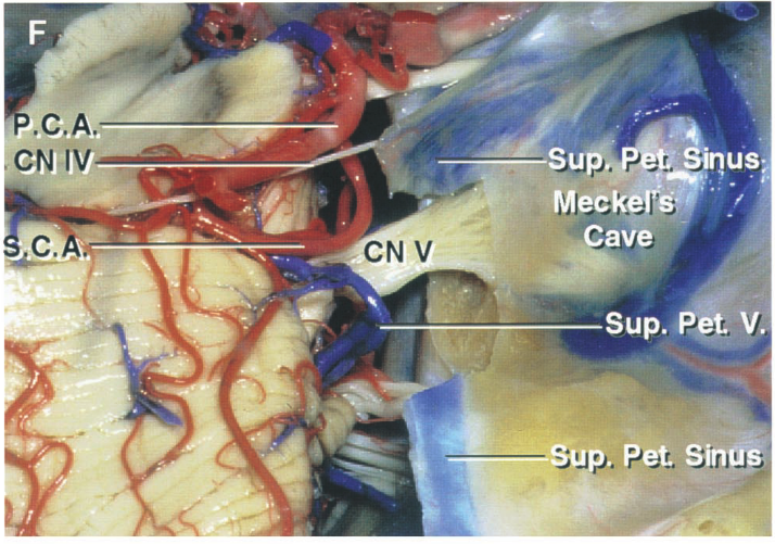 The segment of the superior petrosal sinus, which crosses above the trigeminal nerve and receives the superior petrosal veins, has been removed. 
